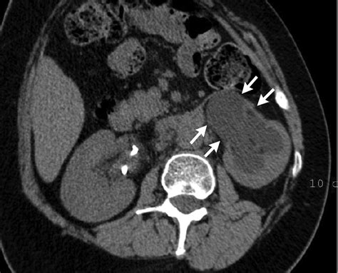 Retroperitoneal Fibrosis