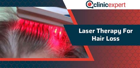 Laser Therapy For Hair Loss | ClinicExpert