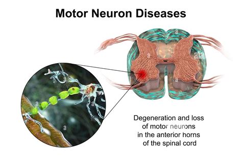 Neurological Rehabilitation - Toticell