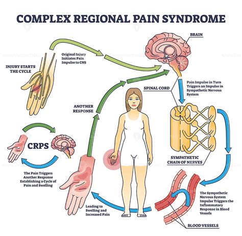 Complex regional pain syndrome or CRPS as painful condition outline diagram - VectorMine