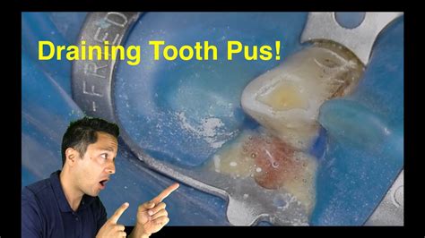 filling up Tooth Abscess Draining Pus!! + Free Endo Gear Guide - regions in the body