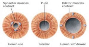 HealthoolA comparison image showing a normal sized pupil, constricted pupil (secondary to heroin ...