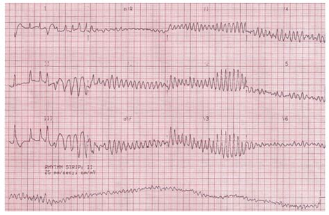 Ventricular Fibrillation