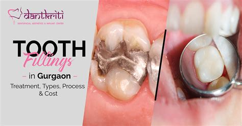 DENTAL FILLINGS- TYPES AND COST; दांतों का, 41% OFF