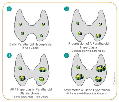 Parathyroid Hyperplasia vs Parathyroid Adenoma | Dr. Larian