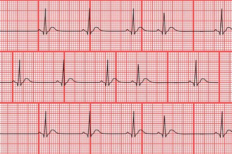 Premature Atrial Contractions Ecg