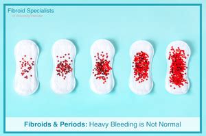 Fibroids & Period Bleeding | Treatment | Fibroid Specialists