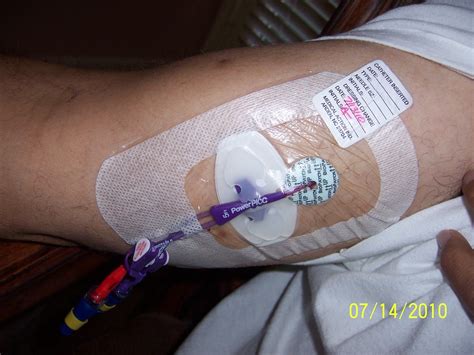 IV PICC LINE CARE PROVIDED BY PALOMA HOME HEALTH AGENCY | Flickr