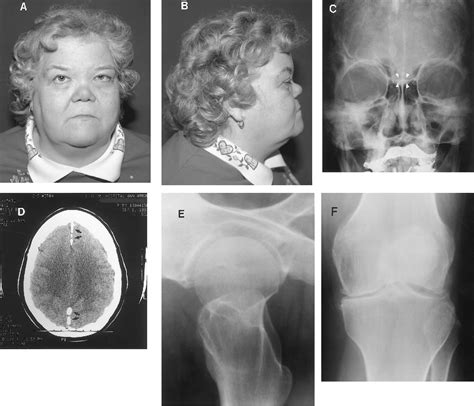 Figure 1 from Marshall syndrome associated with a splicing defect at ...