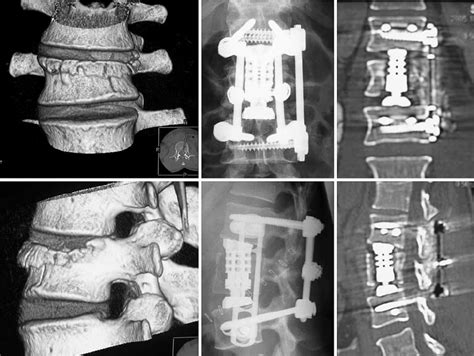 Clinical example of a patient with an L2 incomplete burst fracture ...