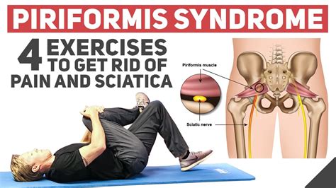 Piriformis Syndrome - Home Stretches & Exercises - YouTube