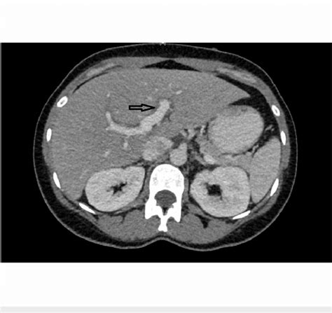 Cross-sectional view of CT scan of abdomen showing peri-portal edema... | Download Scientific ...