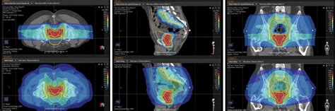 Proton Therapy Case Study – Prostate Cancer - Johns Hopkins Medicine