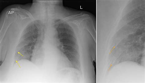 Rib Fractures - Radiology at St. Vincent's University Hospital