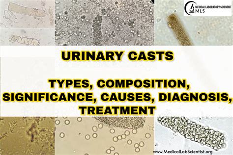 URINARY CASTS: Types, Composition, Significance, Causes, Diagnosis ...