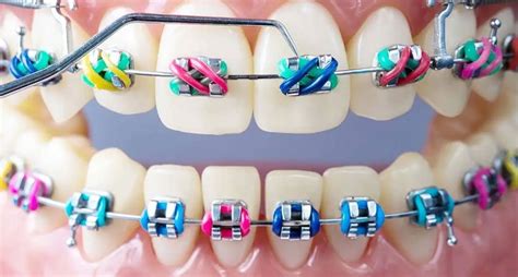 Braces colors wheel - gasmvis