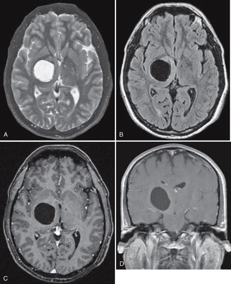 Intracranial Cysts and Cyst-Like Lesions | Radiology Key