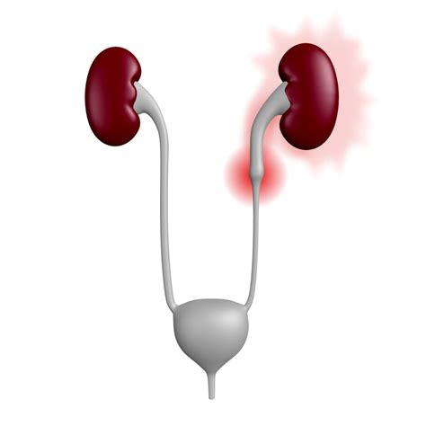 Ureteral Stent Placement - What is a ureteral stent - Urology Austin