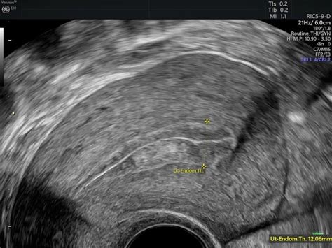 Making the Diagnosis With Endometrial Hyperplasia Ultrasound ...