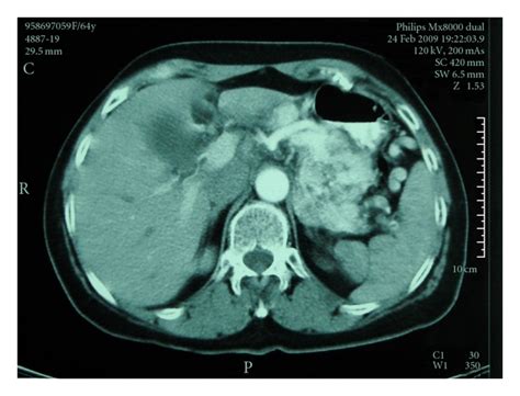 Contrast-enhanced axial CT scan through the pancreas shows a large... | Download Scientific Diagram