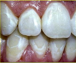 Do Orthodontic Braces Cause White Spots on Teeth? | Jorgensen ...