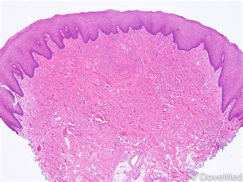 Oral Giant Cell Fibroma