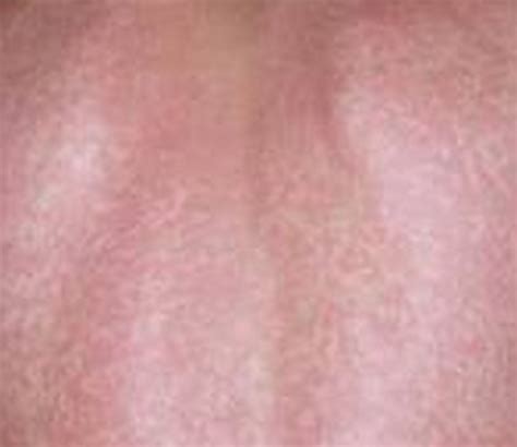 Lamictal rash – Symptoms, Treatment, Images | HubPages
