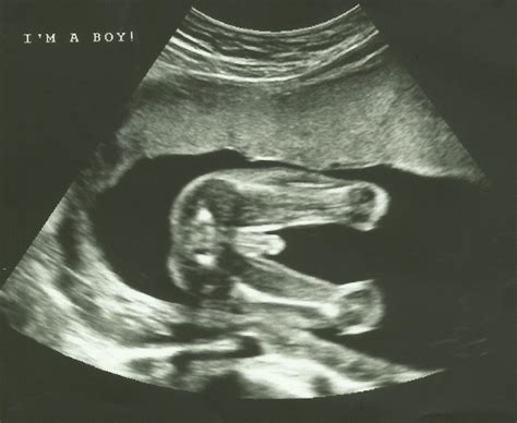 Discovering Your Own Stream ♥: 20 Week Ultrasound - Anatomy Scan
