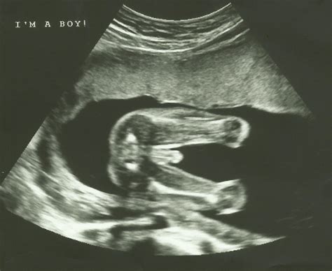 Discovering Your Own Stream ♥: 20 Week Ultrasound - Anatomy Scan