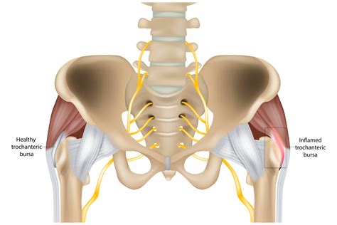 Hip Bursitis