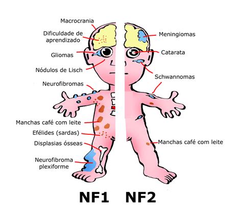 NEUROFIBROMATOSES - Dr LOR Semanalmente: Quais as diferenças entre NF1 e NF2?