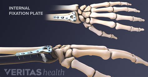 Surgical Options for Treating a Distal Radius Fracture