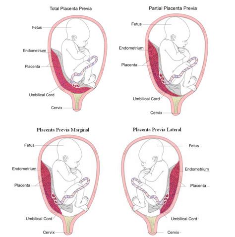 Placenta baja sin sangrado | Actualizado octubre 2024