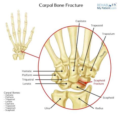 carpal ir Carpal Bones para carpal bone fractures over % of involve the ...