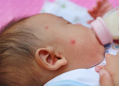 Close up face of infant have a mosquito bites. | Premium Photo