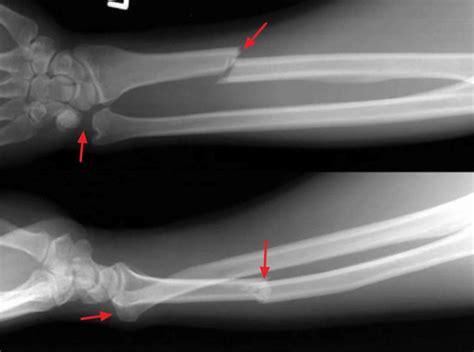 Galeazzi fracture causes, symptoms, diagnosis, treatment & prognosis