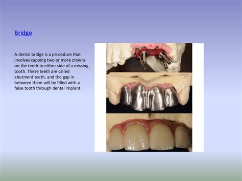 Types of dental prosthesis