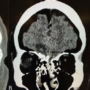 A. excisional blast injury to philtrum. B. Philtrum and nares after ...