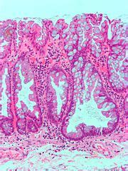 Sessile serrated adenoma - Libre Pathology