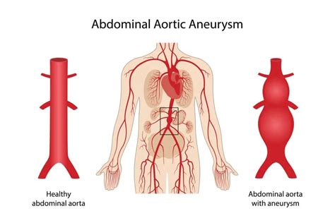 Abdominal Aortic Aneurysm: Causes, Symptoms, and Treatment - Longmore Clinic