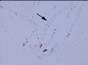 Mucus thread in urine | Medical Laboratories