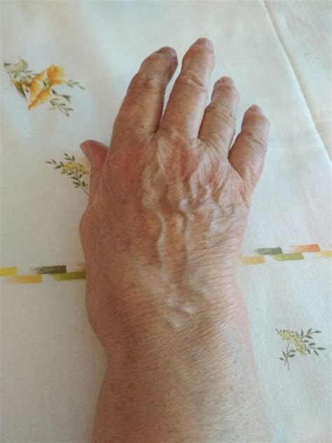 Symptoms of wrist arthritis | General center | SteadyHealth.com