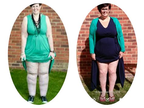 Claire Tickle’s Painful Ten Stone Lipoedema Legs Are Now "Pain-Free And Light As A Feather ...