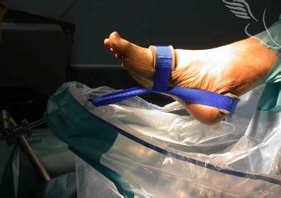 Ankle Arthroscopy - The Foot and Ankle Clinic