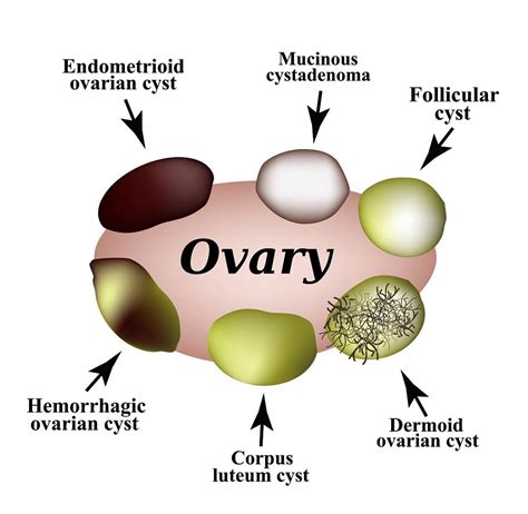 Ovarian cysts - types, symptoms, treatment, remedies, images | CredoWeb