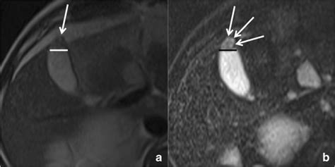 Gallbladder adenomyomatosis: imaging findings, tricks and pitfalls | Insights into Imaging ...