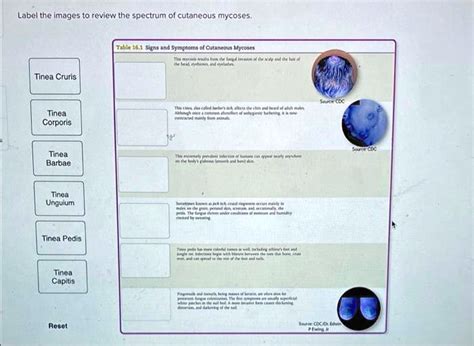 SOLVED: Label the Images to review the spectrum of cutaneous mycoses; Table I: Symptoms of ...