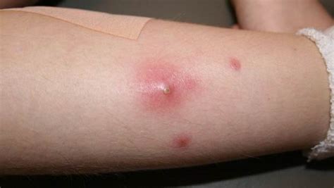 Top Natural Home Remedies for Staph Infection | Khaleej Mag