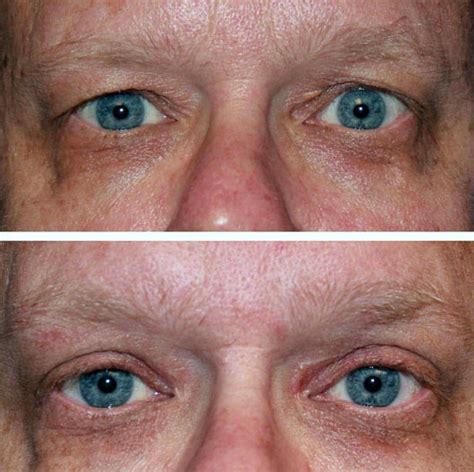 Chemosis After Eyelid Surgery For Men » Eyelid Surgery: Cost, Photos ...