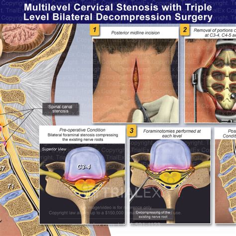 Multilevel Cervical Stenosis with Triple Level Bilateral Decompre...